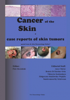 Книга Cancer of the Skin - case reports of skin tumors на ReadRate.com книга Cancer of the Skin - case reports of skin tumors